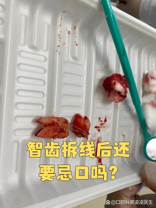 植完牙拆线痛吗-图3 植完牙拆线痛吗-图3