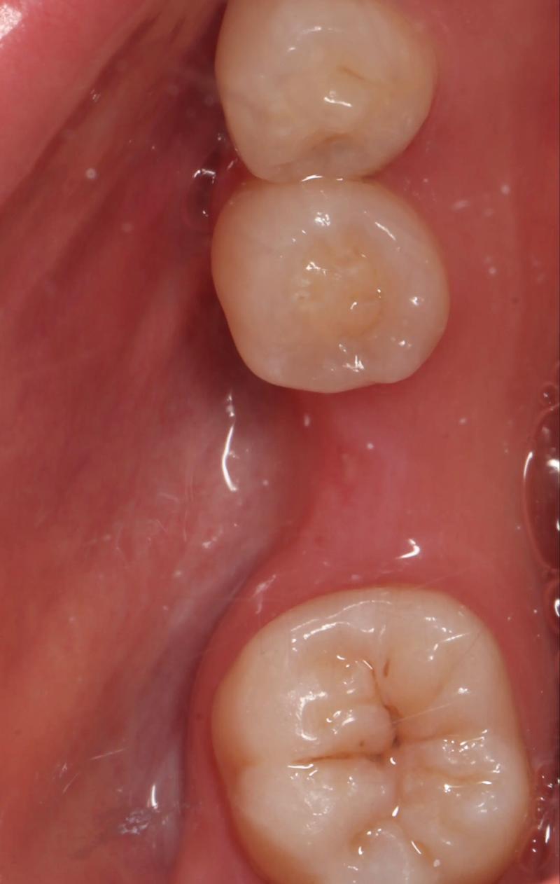 牙周植骨半年后-图2