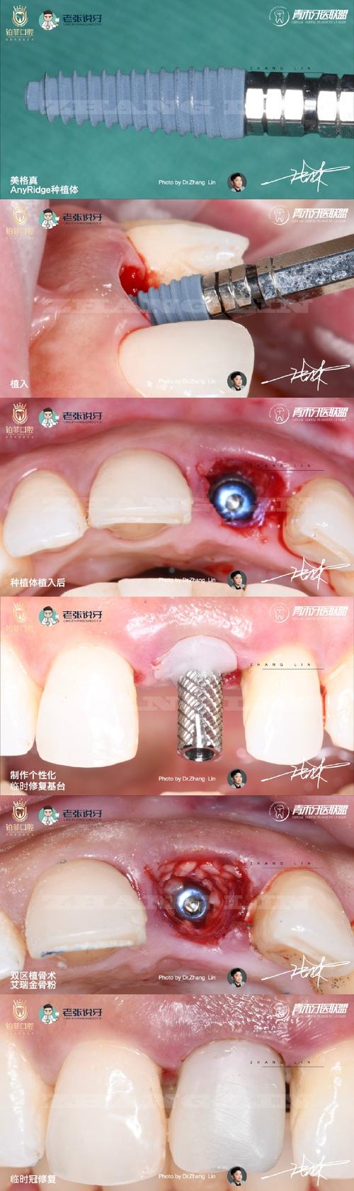 牙周植骨半年后-图3