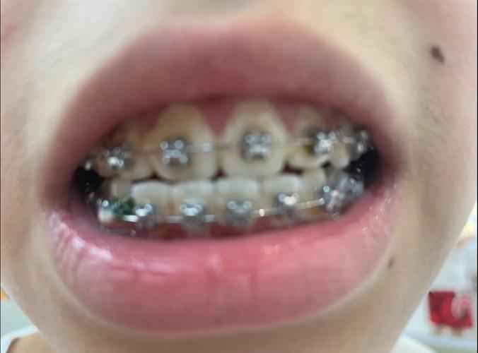 金属过敏者能做牙齿正畸吗？材料会引发过敏吗？-图1
