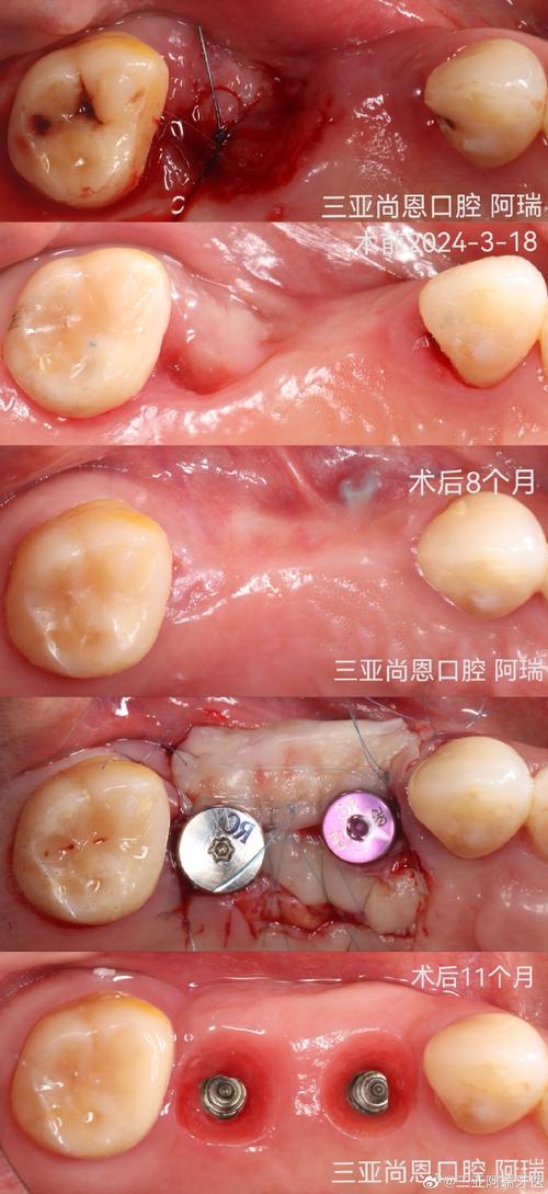 同福医植牙效果到底好不好?真实效果与体验如何?-图3 同福医植牙效果到底好不好?真实效果与体验如何?-图3