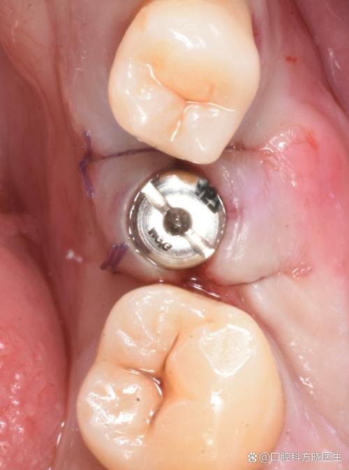 宜昌有植过牙的-图2 宜昌有植过牙的-图2