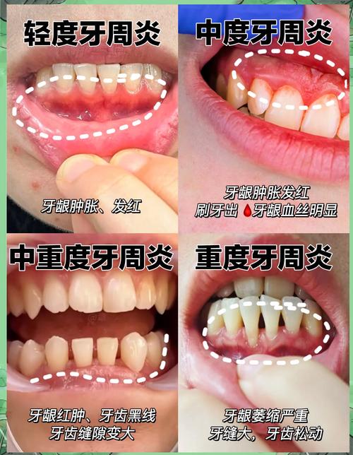 正畸期间得了牙周炎-图2