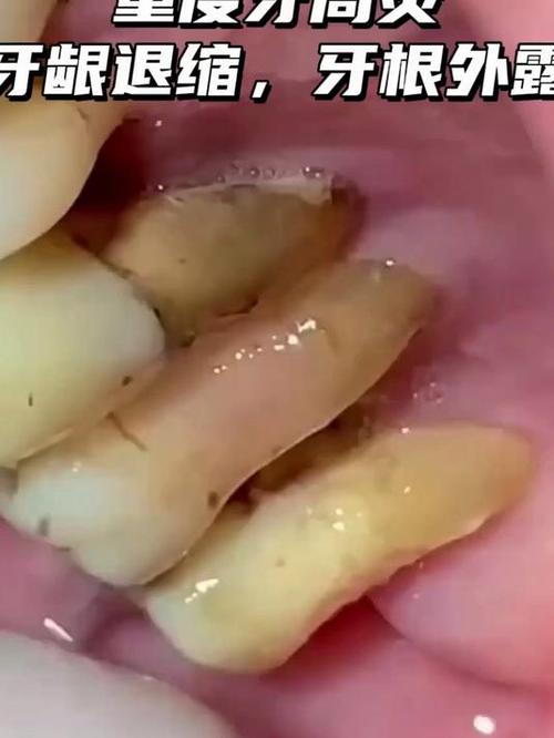 正畸期间得了牙周炎-图3