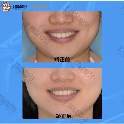 tweed正畸特点-图2