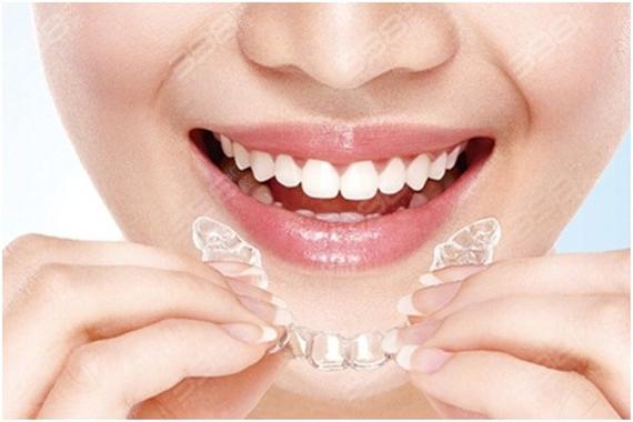 spark隐形正畸-图1