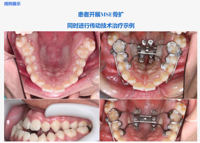 正畸Ubegg技术-图1