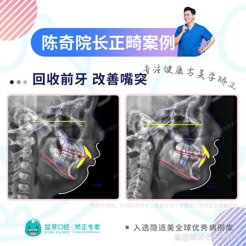 正畸Ubegg技术-图2
