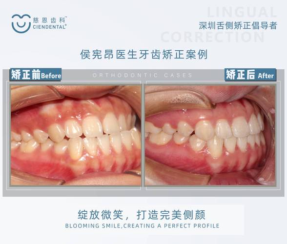 正畸Ubegg技术-图3