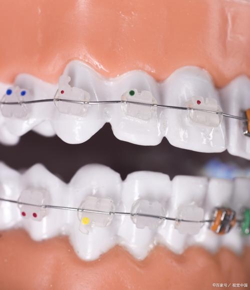 爱丁堡 正畸 北京-图2