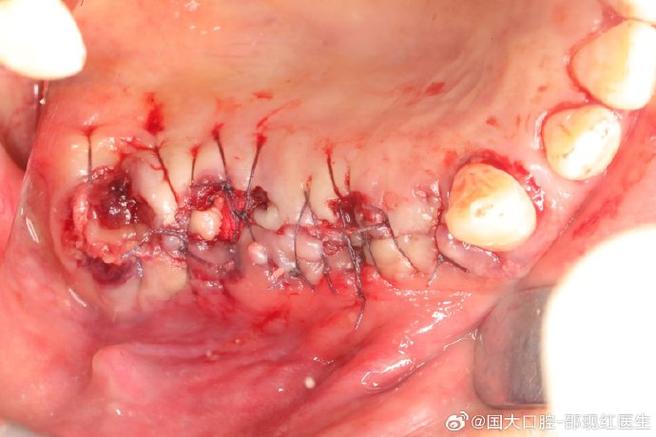 种牙植骨创伤面-图1