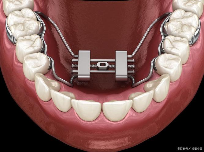 正畸Damon系统矫正效果如何？与传统矫正相比有何优势？-图3
