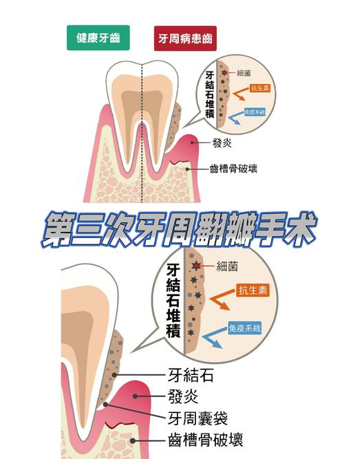 牙周翻瓣 植骨-图2