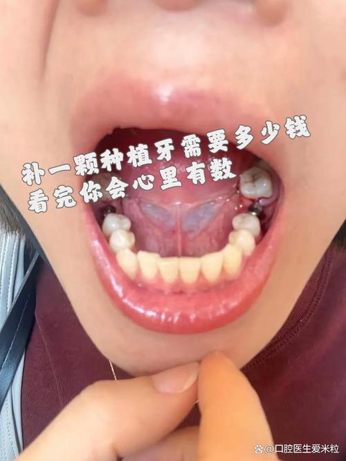 种植牙的种植过程有哪些关键步骤？-图3