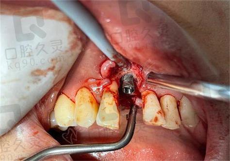 植牙骨失败案例-图2