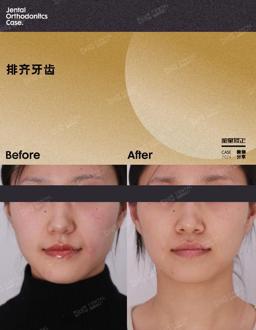 先正畸后正颌再正畸，为何需分三步治疗？-图2