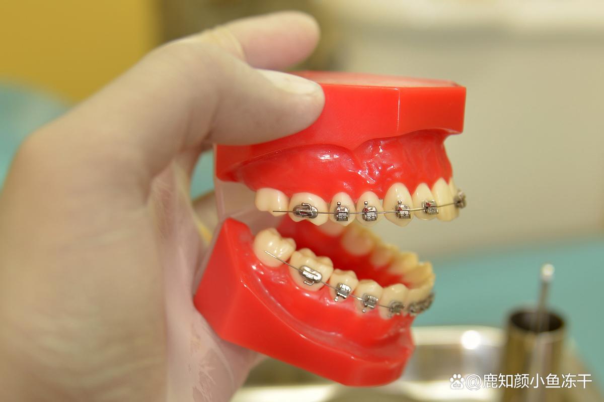 广州省口腔植牙多少钱？效果好不好？医院怎么选靠谱？-图3