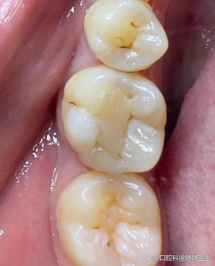 正畸力度过大牙髓炎-图2 正畸力度过大牙髓炎-图2