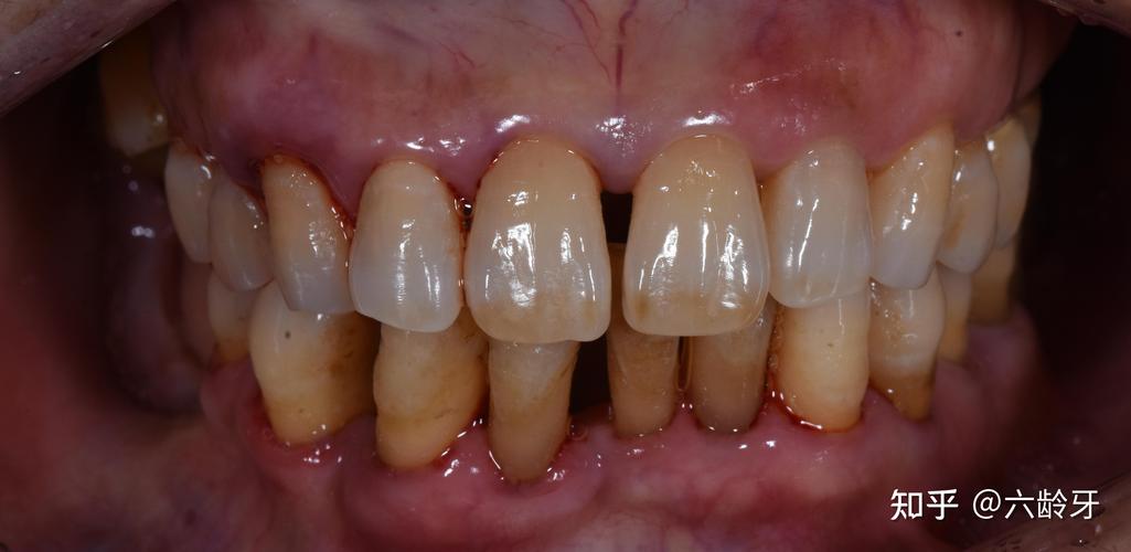 正畸力度过大牙髓炎-图1 正畸力度过大牙髓炎-图1