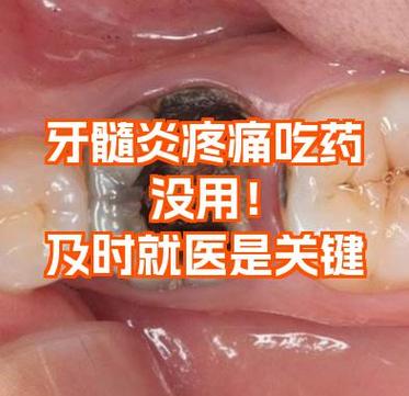 正畸力度过大牙髓炎-图3 正畸力度过大牙髓炎-图3