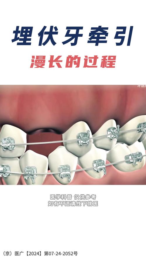 正畸前牙三角形牵引-图3