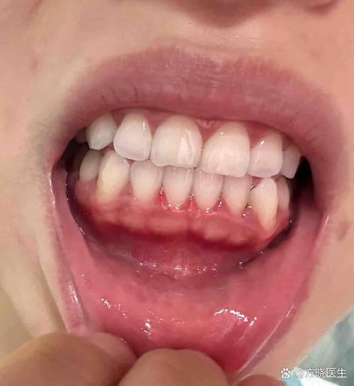 牙槽植骨 发白-图1