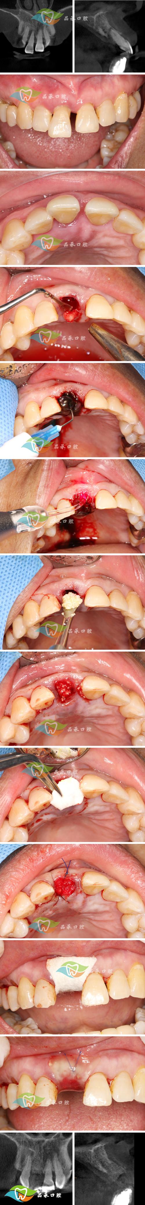 牙槽植骨 发白-图2