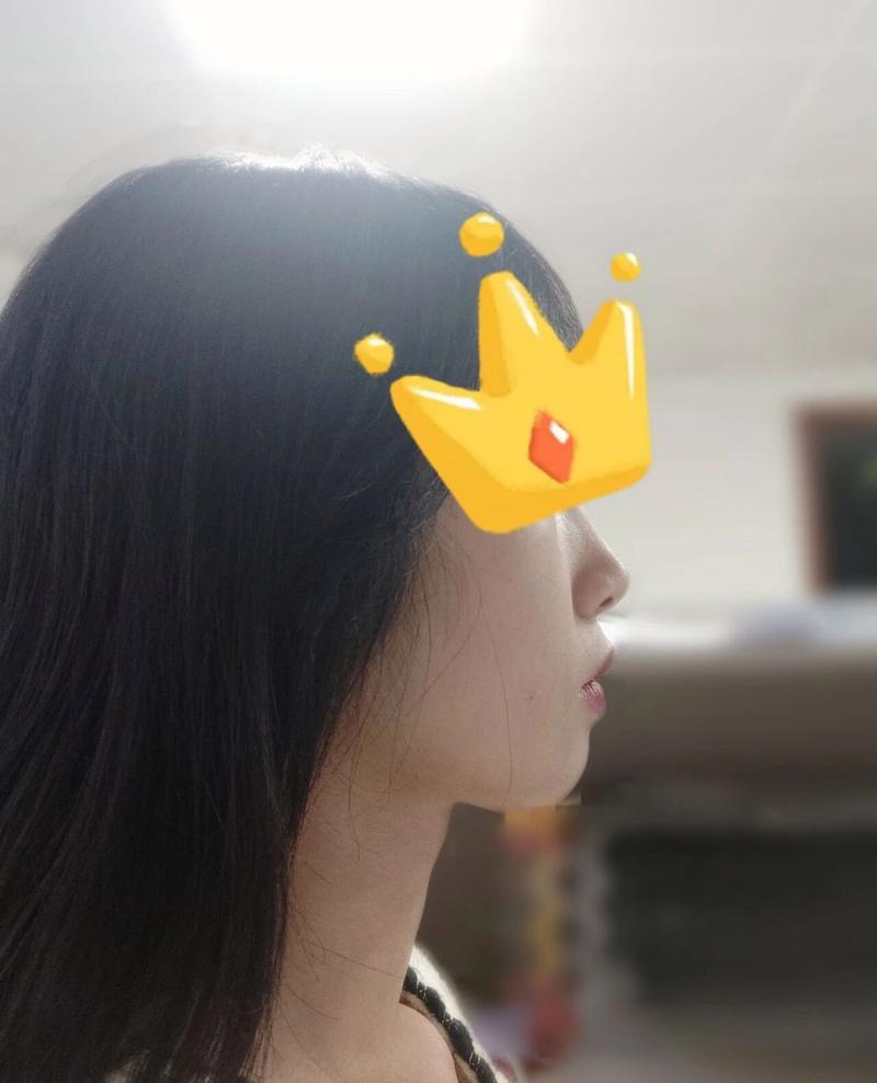 骨性二类错颌患者能通过正畸治疗改善吗?-图2 骨性二类错颌患者能通过正畸治疗改善吗?-图2