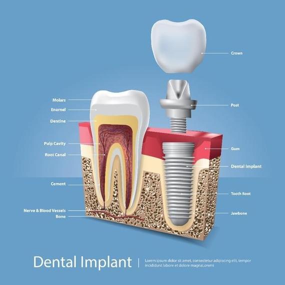 植牙诺贝尔系统效果如何？有哪些独特优势？-图1
