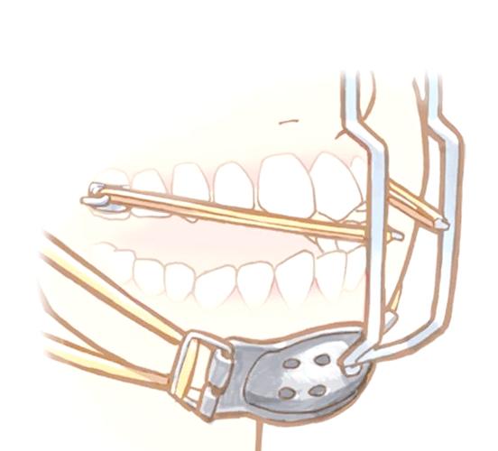 正畸一类牵引示意图-图1 正畸一类牵引示意图-图1