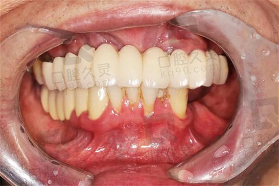 明星全口腔植牙-图1