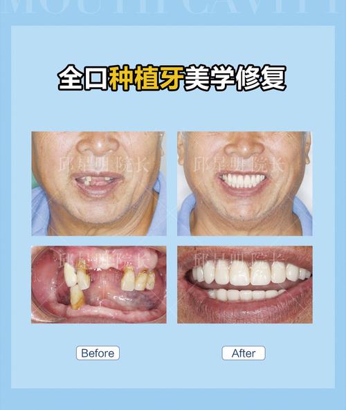 明星全口腔植牙-图2
