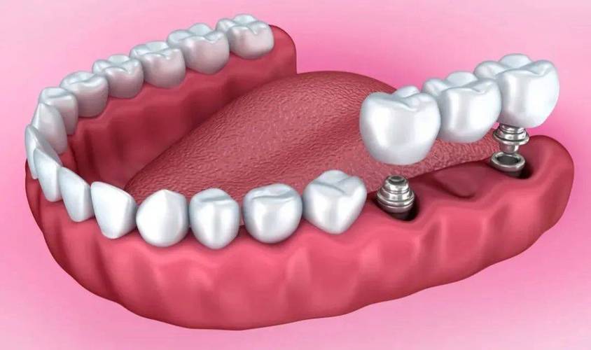 丹东哪植牙便宜-图2