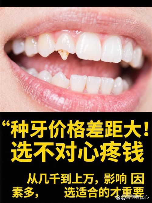 丹东哪植牙便宜-图1