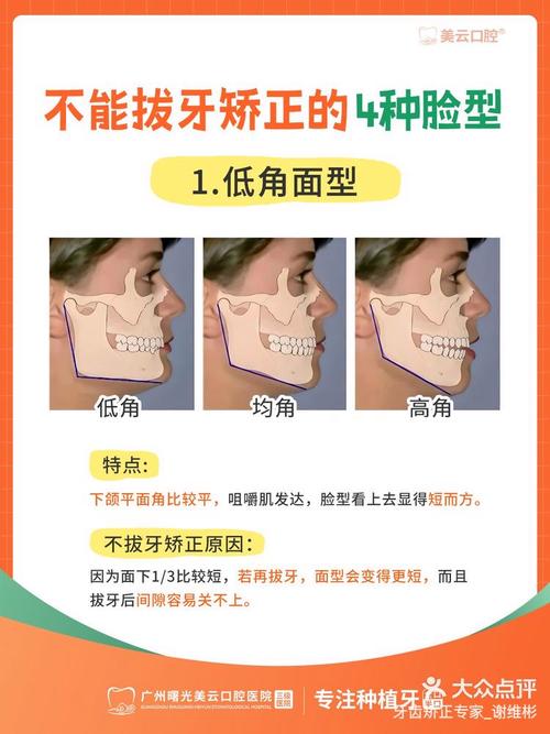 正畸不拔牙会毁脸吗-图1