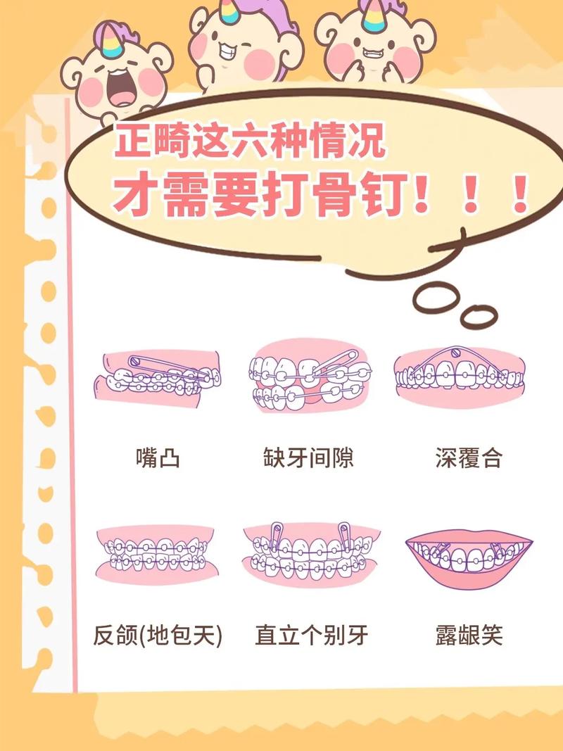 正畸骨钉什么时候需要上？医生如何确定最佳植入时机？-图1