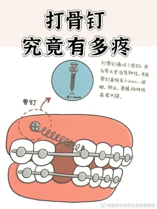 正畸骨钉什么时候需要上？医生如何确定最佳植入时机？-图3