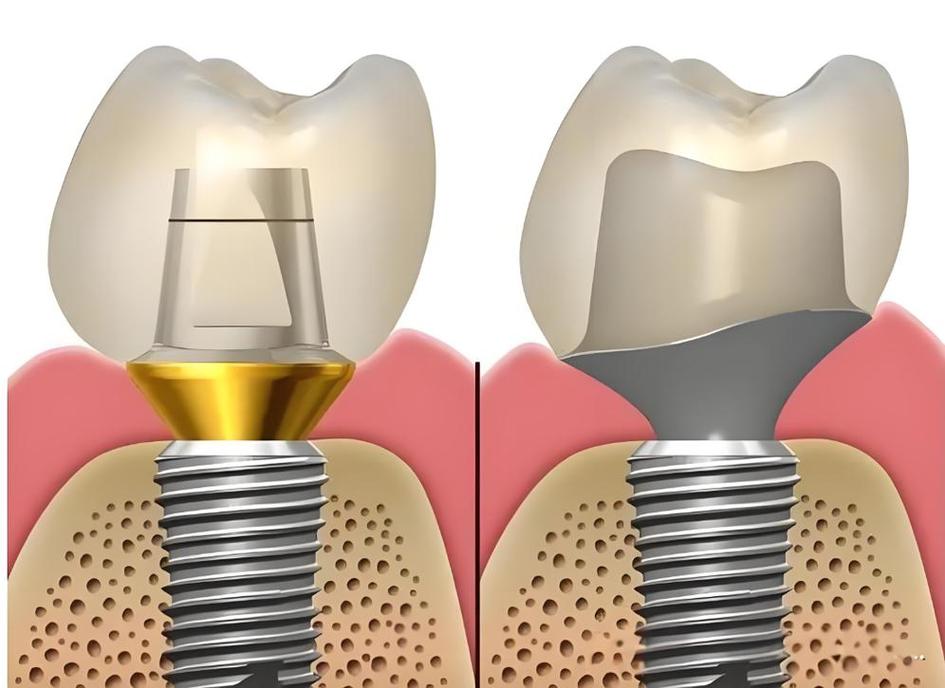 植牙外提升咳嗽-图2 植牙外提升咳嗽-图2