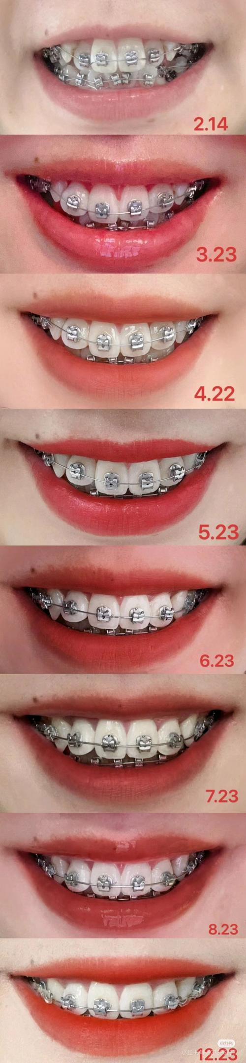 江西省口腔医院正畸效果如何?技术靠谱吗?值得选择吗?-图2 江西省口腔医院正畸效果如何?技术靠谱吗?值得选择吗?-图2