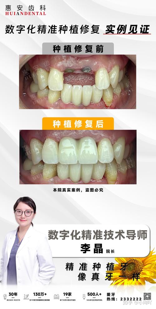 植牙美容修复类-图1 植牙美容修复类-图1