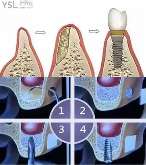 种植牙植骨运动-图3