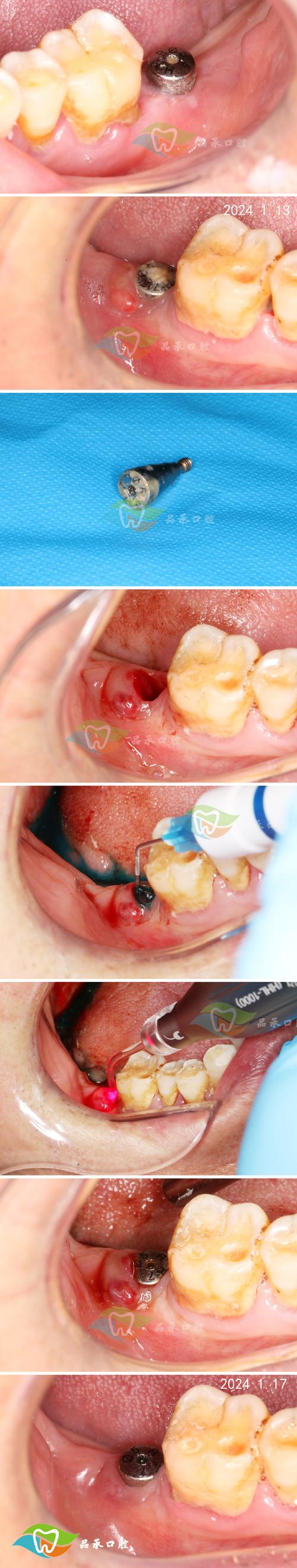 植牙后牙龈变白-图1