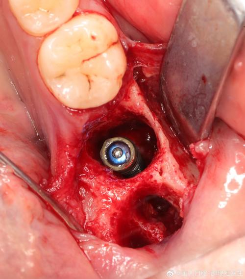 种植牙植骨肿痛-图1