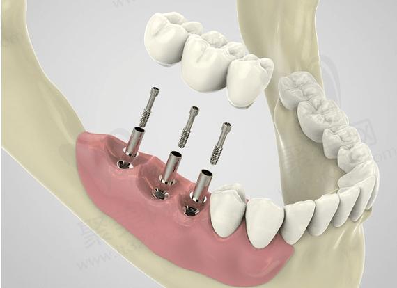 罗湖植牙哪里好？这么多机构怎么选才靠谱？-图1