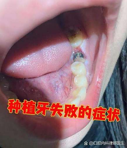 植牙后为何看不见牙根？是正常情况还是存在问题？需要处理吗？-图1