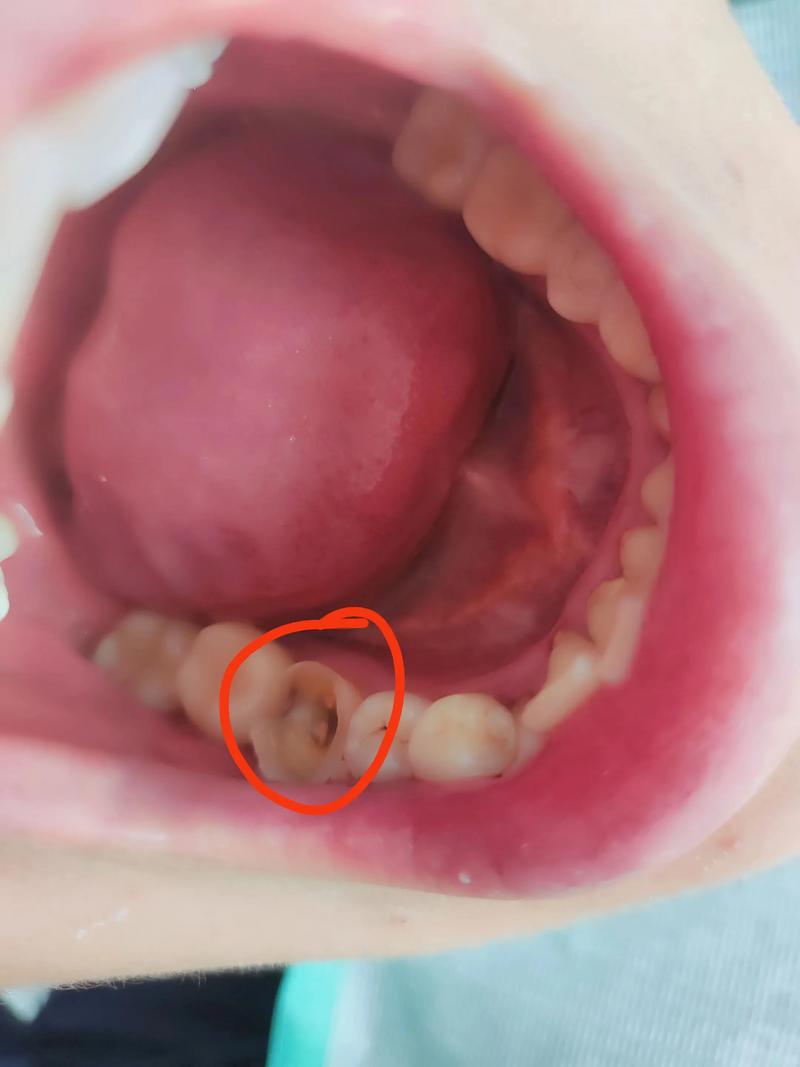 植牙后为何看不见牙根？是正常情况还是存在问题？需要处理吗？-图2