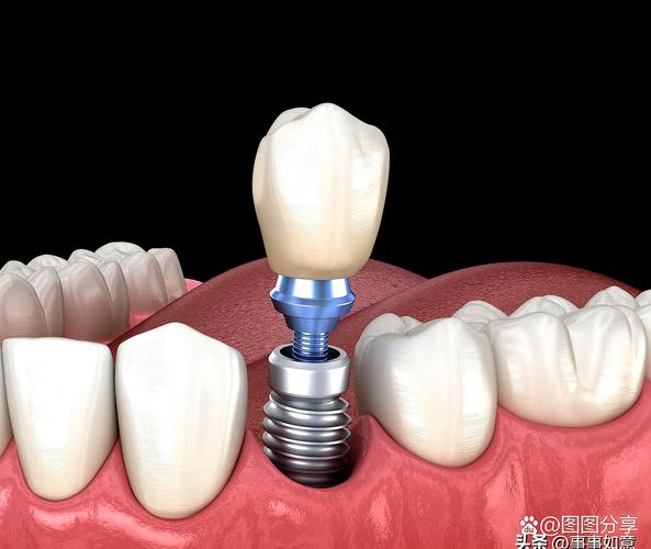 植牙的图片大全-图1