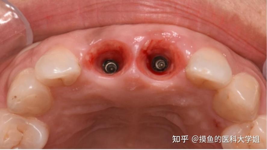 种植牙做好后，效果能维持多久？需注意哪些问题？-图1