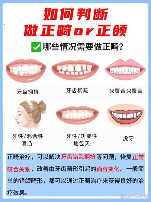 正颌前必须要正畸吗-图2