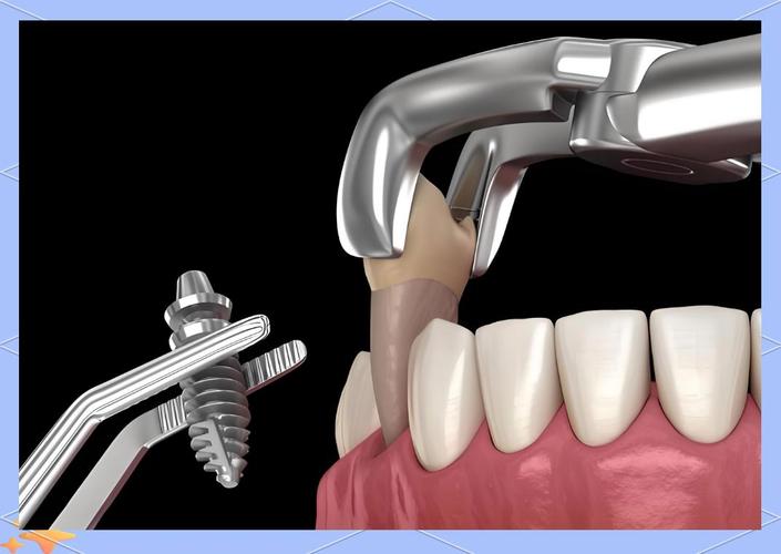 瑞士的植牙系统-图1